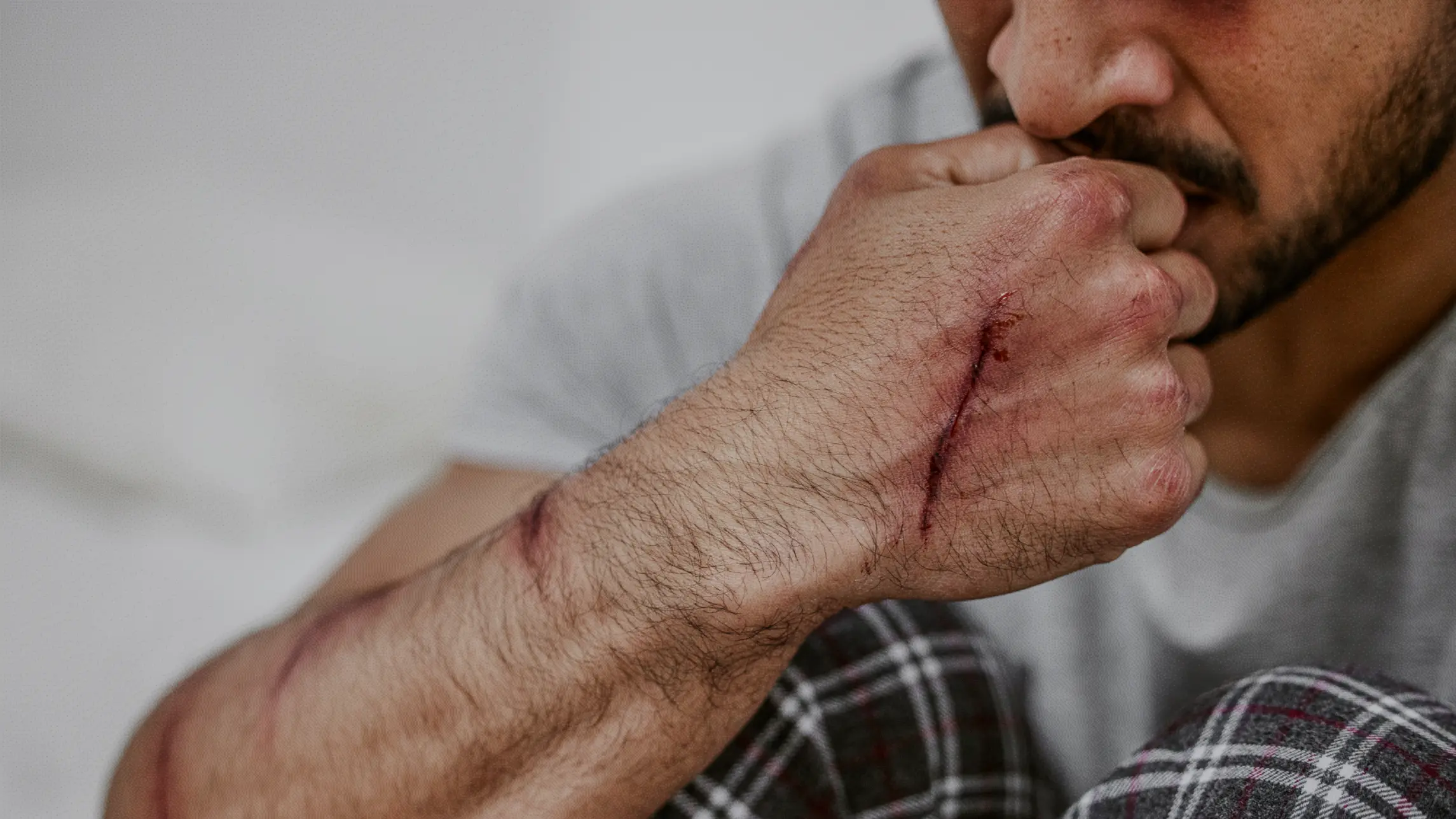 Man with scars on arm biting nails sitting down